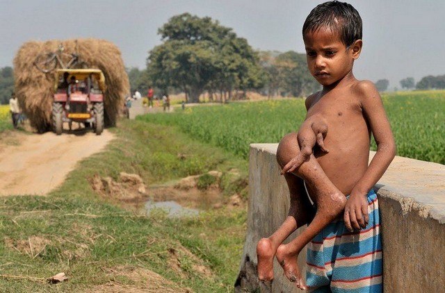 Boy With Twin Growing Out Of Stomach