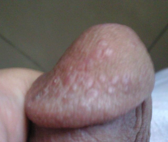 Dark Red Spots On Penis Head Pictures