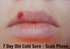 Abreva Cold Sore Stages
