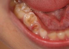 Acid Erosion Teeth