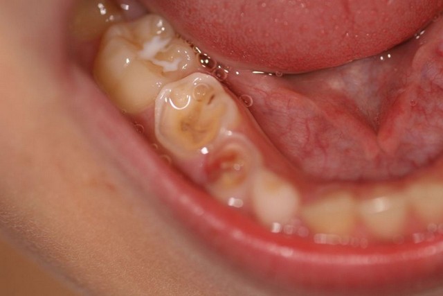 Acid Erosion Teeth